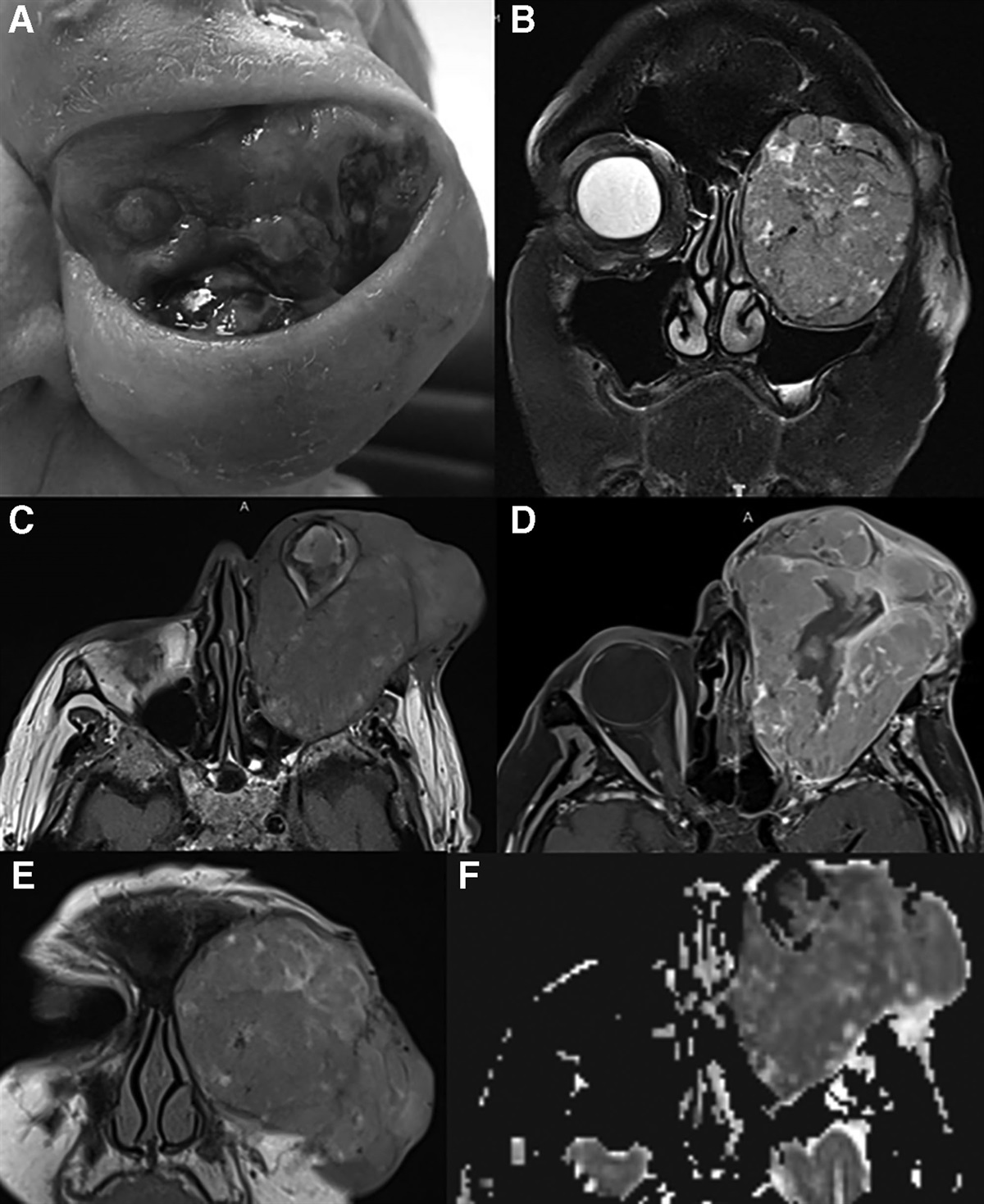 Radiological Characteristics of Orbital Melanoma