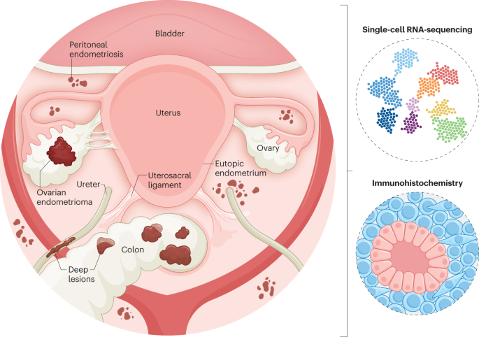 A novel resource to study endometriosis at the single-cell level