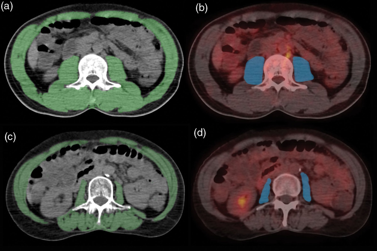 Usefulness of 18F-FDG PET/computed tomography metabolic parameters in predicting sarcopenia and prognosis of treatment-naive patients with non-small cell lung cancer