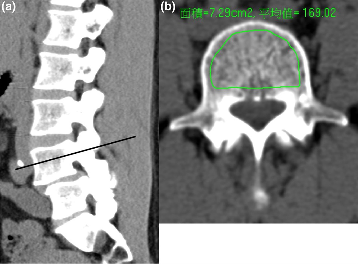Shorter screw lengths in dynamic Dynesys fixation have less screw loosening: From clinical investigation to finite-element analysis