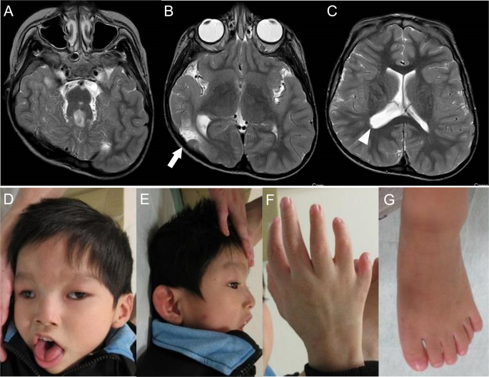 A deep intronic TCTN2 variant activating a cryptic exon predicted by SpliceRover in a patient with Joubert syndrome