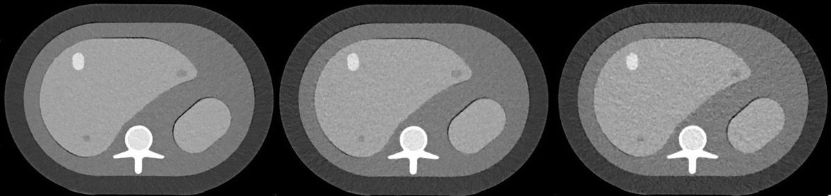 Photon-Counting Detector CT With Quantum Iterative Reconstruction: Impact on Liver Lesion Detection and Radiation Dose Reduction