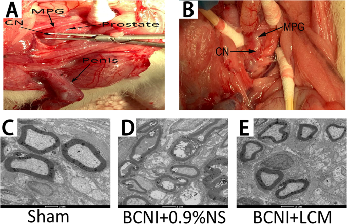 Lacosamide alleviates bilateral cavernous nerve injury-induced erectile dysfunction in the rat model by ameliorating pathological changes in the corpus cavernosum