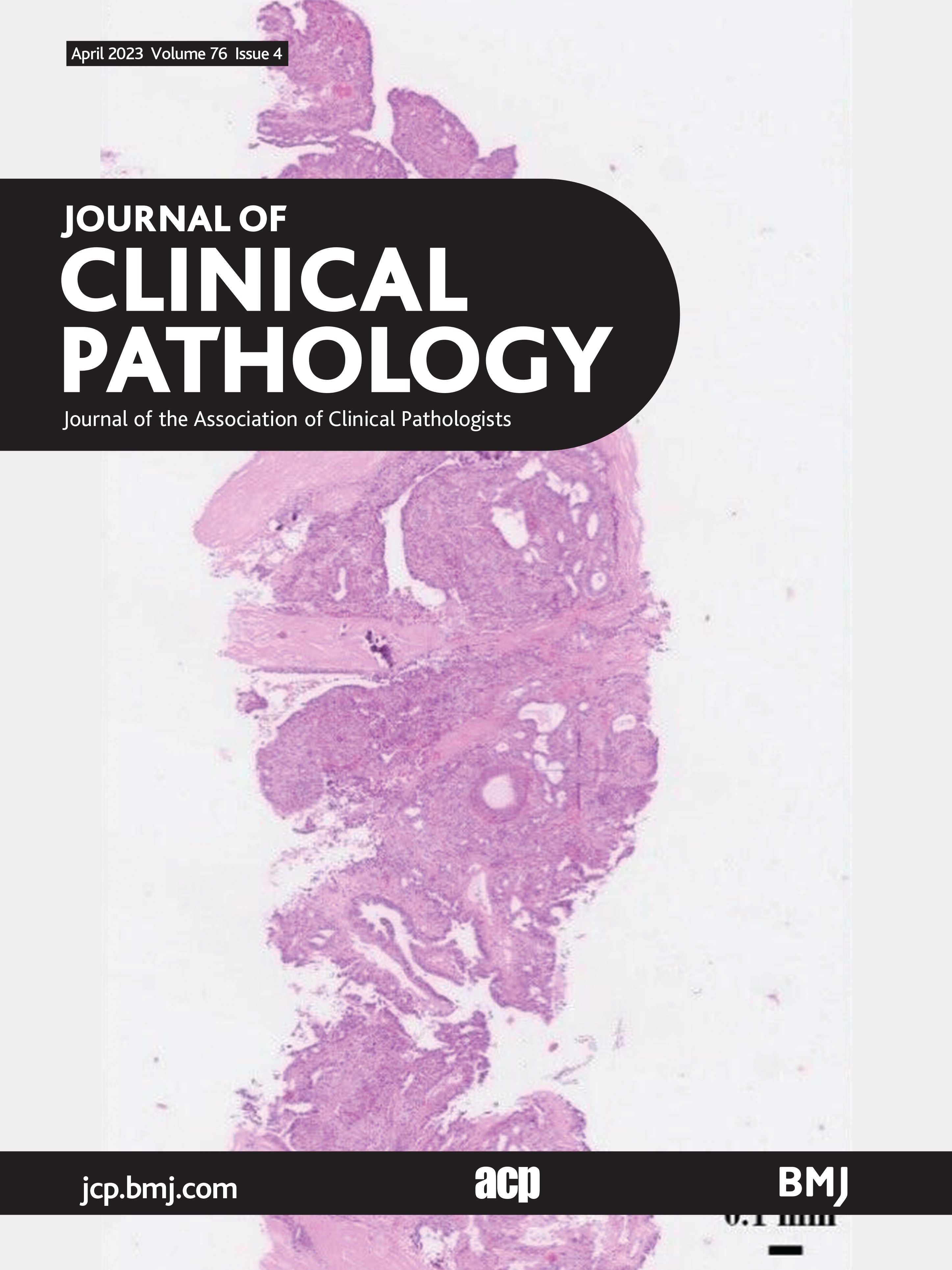 Clinicopathologic analysis of patients undergoing repeat transurethral resection of bladder tumour following an initial diagnosis of urothelial carcinoma with lamina propria invasion and variant/divergent histology