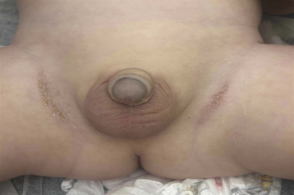 Crusted Papules in the Diaper Region: Challenge