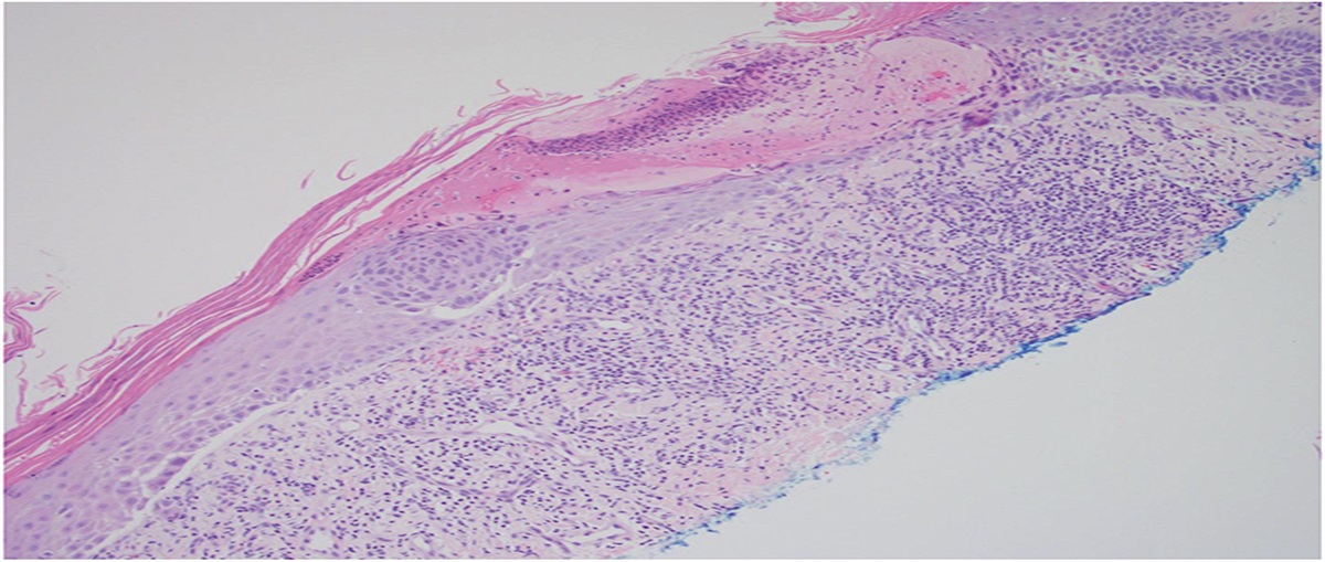 Pagetoid Spread in Basal Cell Carcinoma: Potential for Misdiagnosis
