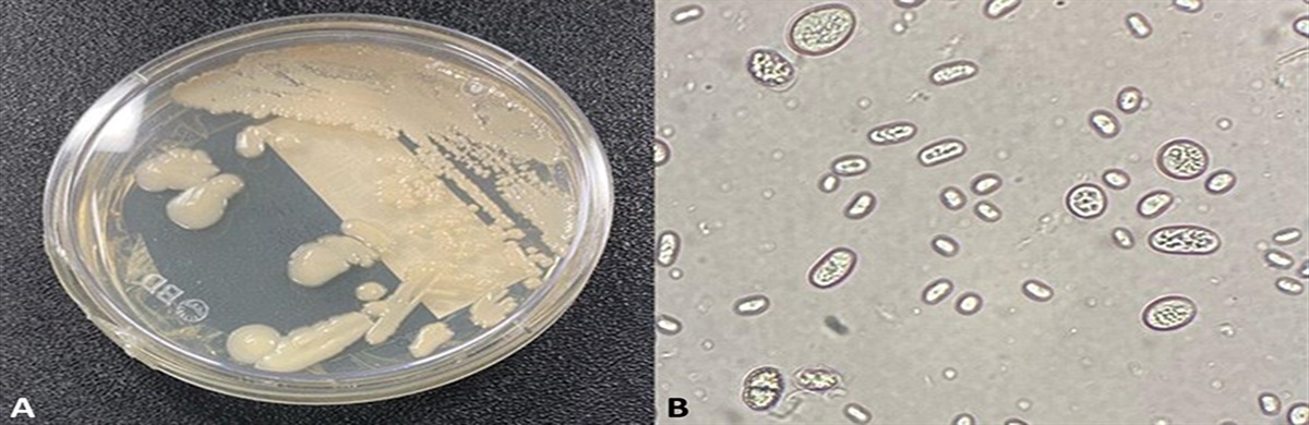 Disseminated Protothecosis Due to Prototheca zopfii and Literature Review