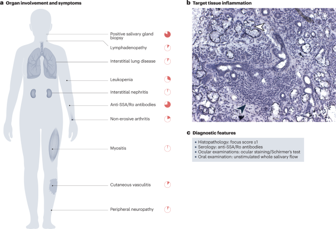 Genetics and epigenetics of primary Sjögren syndrome: implications for future therapies