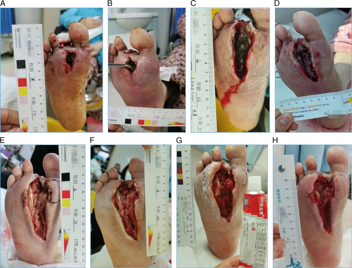A Multidisciplinary Team Approach for Diabetic Foot Ulcer: A Case Study