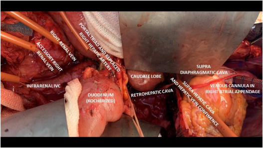 Surgical Management of Renal Cell Carcinoma with Inferior Vena Cava Tumor Thrombus