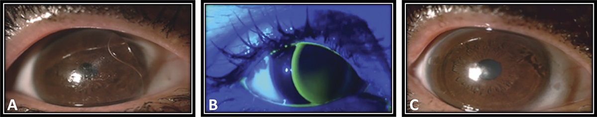 The Comparison of Soft HydroCone (Toris K) Silicone Hydrogel and Rigid Gas-Permeable Contact Lenses in Patients With Posterior Microphthalmos