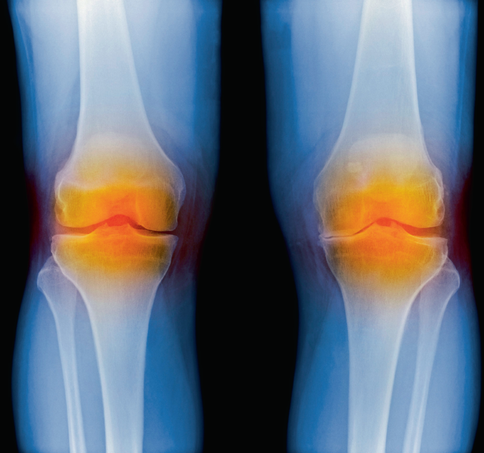 The potential contribution of in silico studies to improved treatment of osteoarthritis