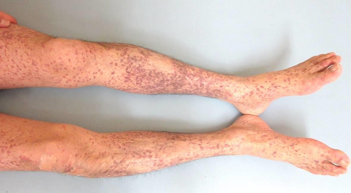 Hypocomplementemic Urticarial Vasculitis Syndrome