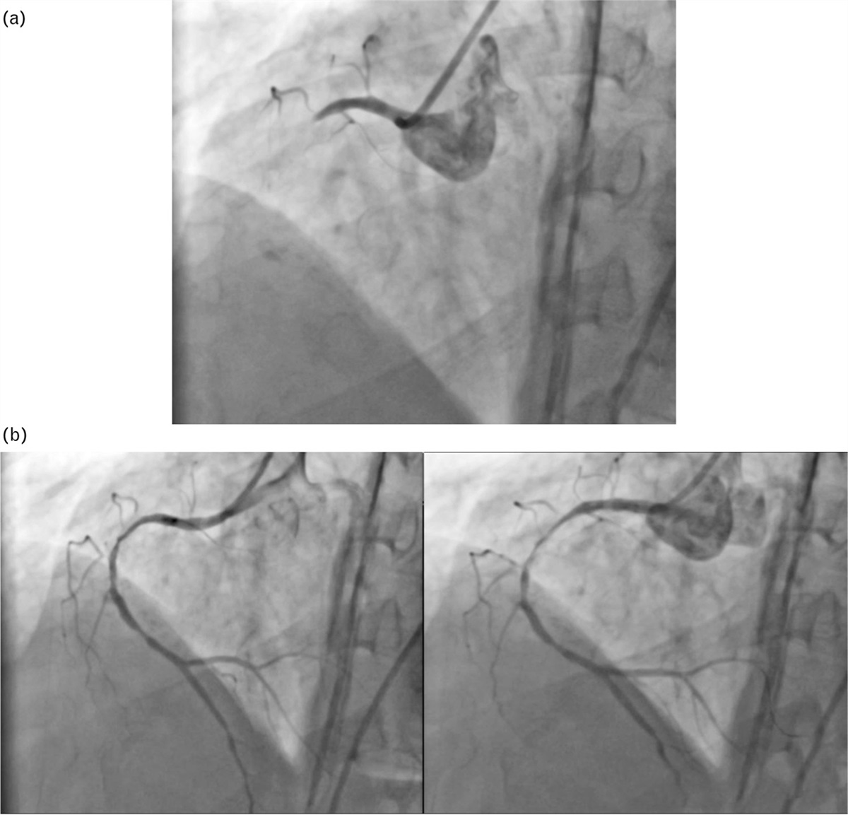 Curious case of stent loss managed by a novel escort guiding technique