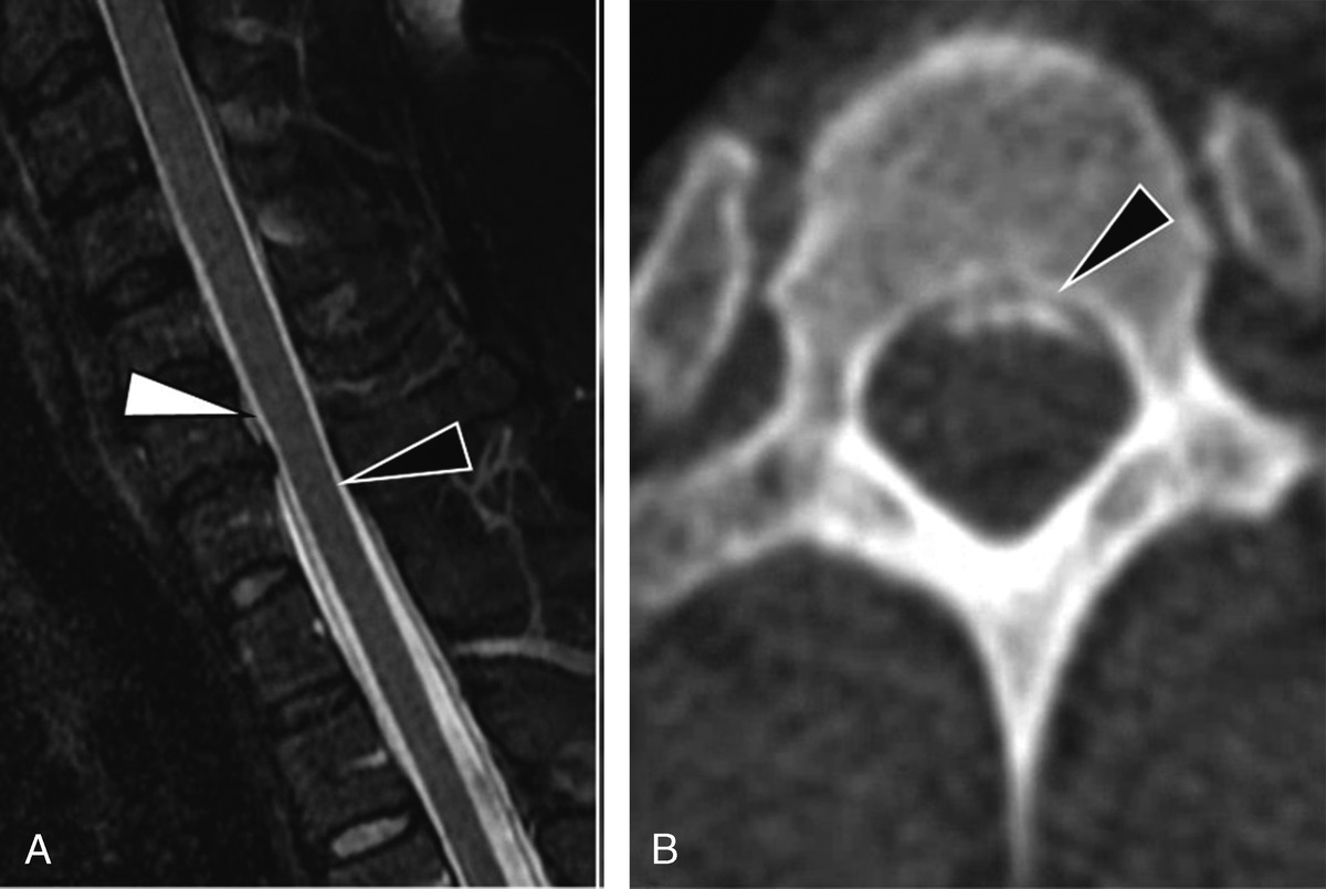 The “Crossing Collection Sign”: A Diagnostic Tool on Spine Magnetic Resonance Imaging For Localizing Cerebrospinal Fluid Leak