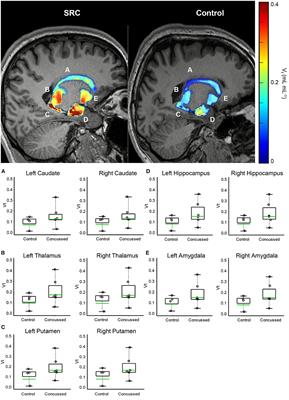 Microglial activation persists beyond clinical recovery following sport concussion in collegiate athletes