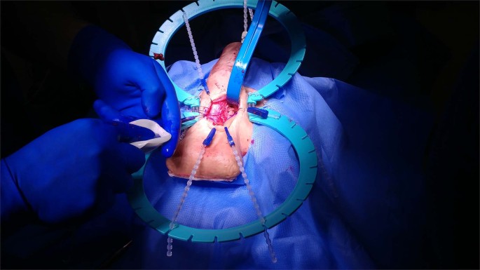 Education in penile prosthesis implantation
