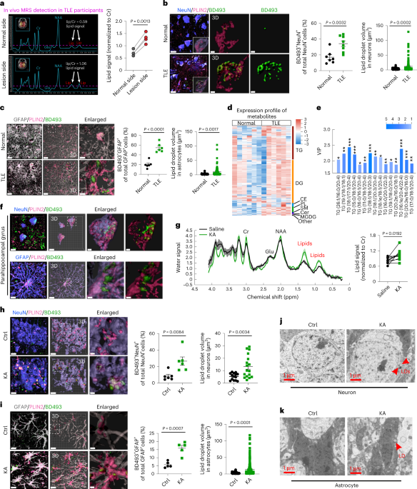 Lipid-accumulated reactive astrocytes promote disease progression in epilepsy