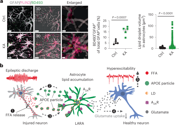 Abnormal lipid metabolism shapes astrocyte reactivity in patients with epilepsy