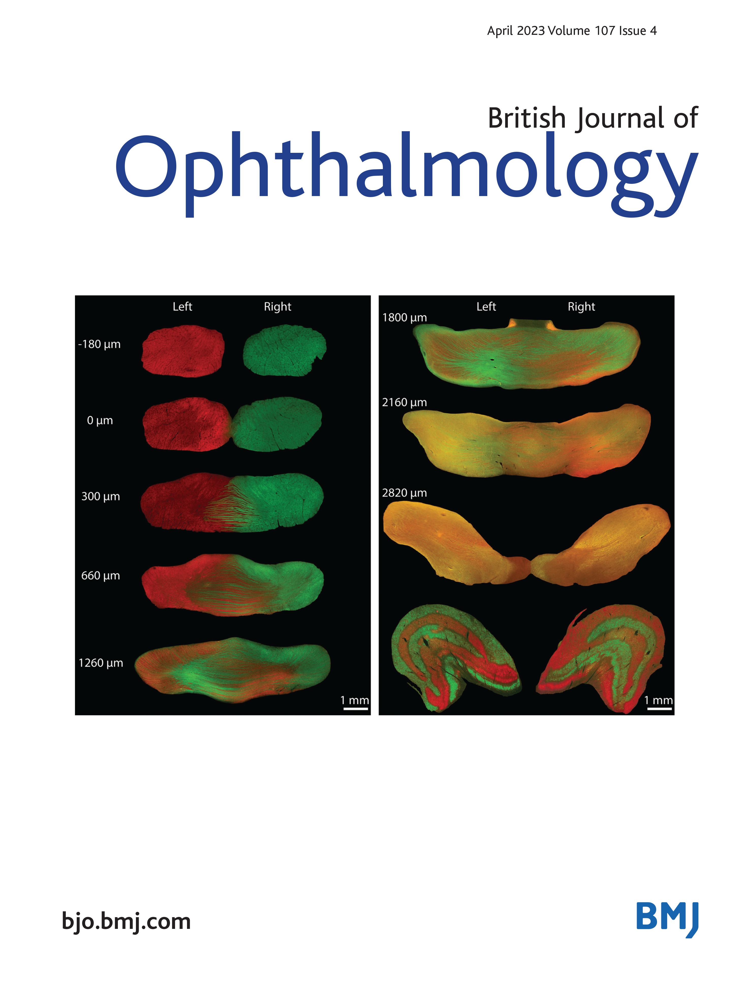 Population-based study on the prevalence, clinical characteristics and vision-related quality of life in patients with corneal opacity resulting from infectious keratitis: results from the Corneal Opacity Rural Epidemiological study