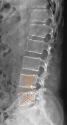 Radiological outcomes of PEEK rods in patients with lumbar degenerative diseases: A minimum 5-year follow-up