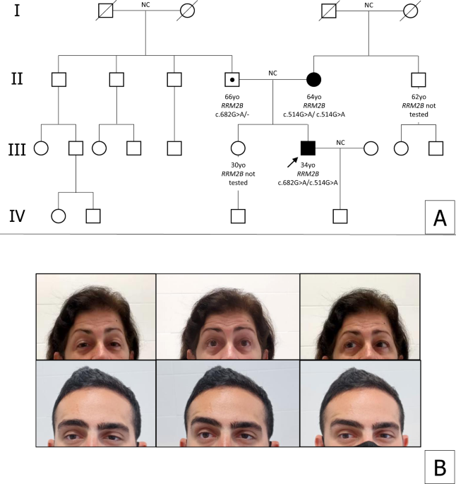 Identification of two novel RRM2B variants associated with autosomal recessive progressive external ophthalmoplegia in a family with pseudodominant inheritance pattern