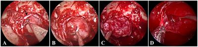 Endoscopic endonasal surgery for non-invasive pituitary neuroendocrinology tumors with incomplete pseudocapsule