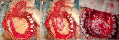 Efficacy of modified EDAS combined with a superficial temporal fascia attachment-dural reversal surgery for the precise treatment of ischemic cerebrovascular disease