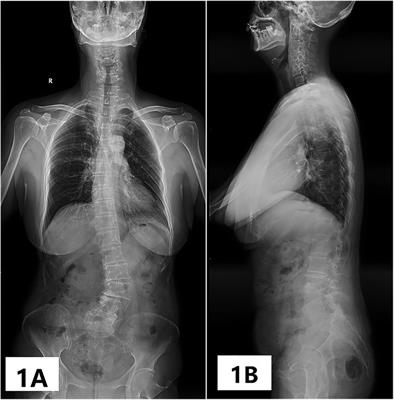 Characteristics of the paravertebral muscle in adult degenerative scoliosis with PI-LL match or mismatch and risk factors for PI-LL mismatch