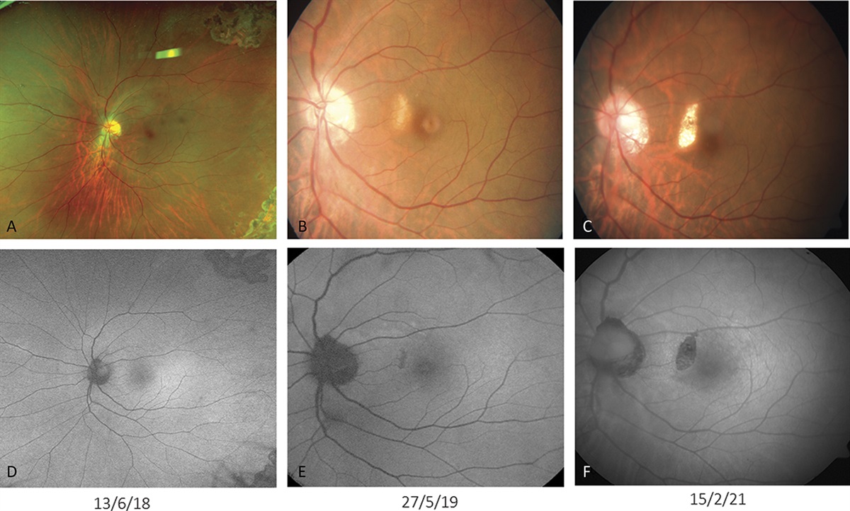 Diagnostic and Therapeutic Challenge