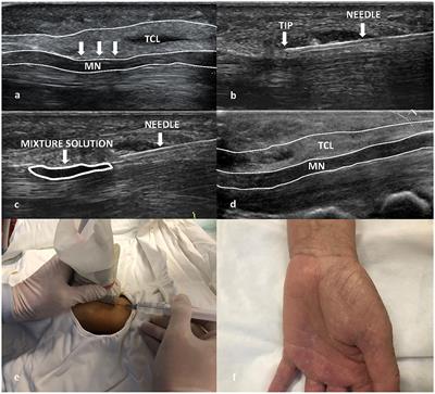Comparison efficacy of ultrasound-guided needle release plus corticosteroid injection and mini-open surgery in patients with carpal tunnel syndrome