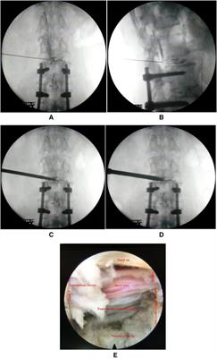 Comprehensive comparison of three techniques for the treatment of adjacent segment degeneration after lumbar fusion