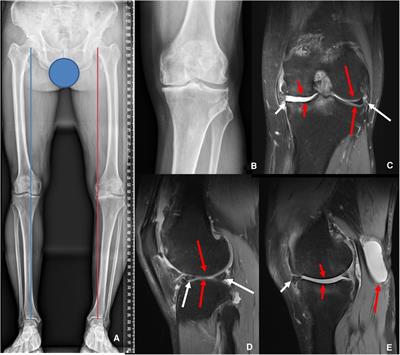 Simultaneous arthroscopic cystectomy and unicompartmental knee arthroplasty for the management of partial knee osteoarthritis with a popliteal cyst: A case report