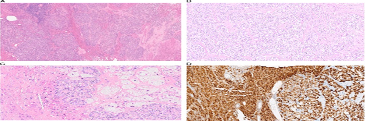 Well-differentiated Sertoli-Leydig Cell Tumors (SLCTs) Are Not Associated With DICER1 Pathogenic Variants and Represent a Different Tumor Type to Moderately and Poorly Differentiated SLCTs