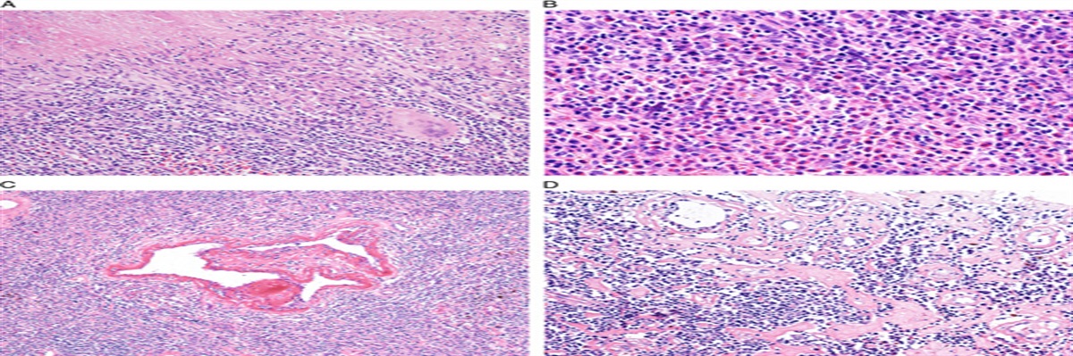 Challenges in the Diagnosis of Epstein-Barr Virus-positive Inflammatory Follicular Dendritic Cell Sarcoma: Extremely Wide Morphologic Spectrum and Immunophenotype
