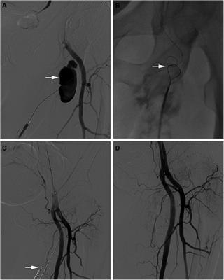 Case report: Successful and effective percutaneous closure of a deep femoral artery pseudoaneurysm using proglide device