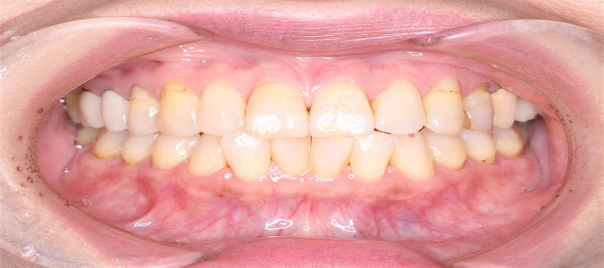 A Case of Oral Cenesthopathy Treated With the Combination of Brexpiprazole and Mirtazapine