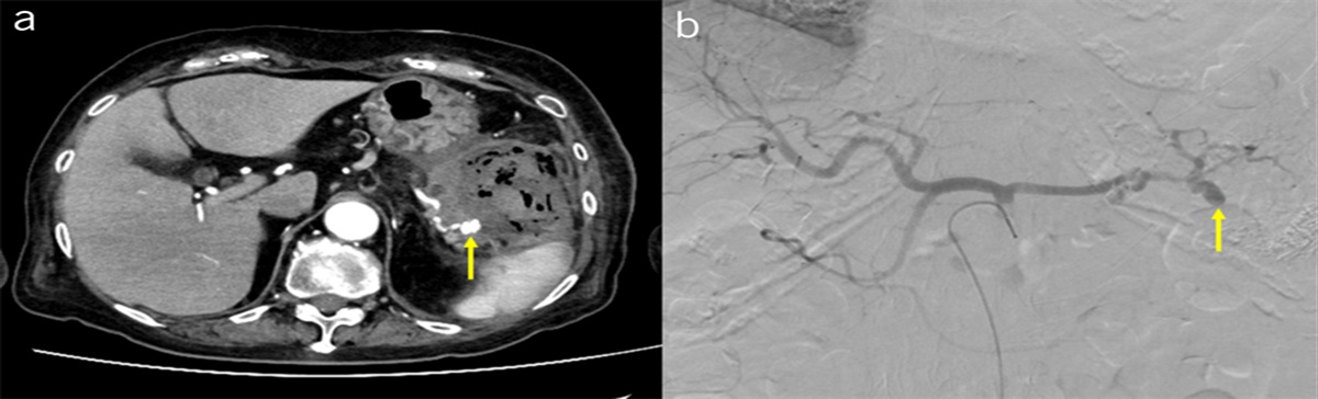 Rupture Splenic Artery Aneurysm Caused by Pancreatic Cancer