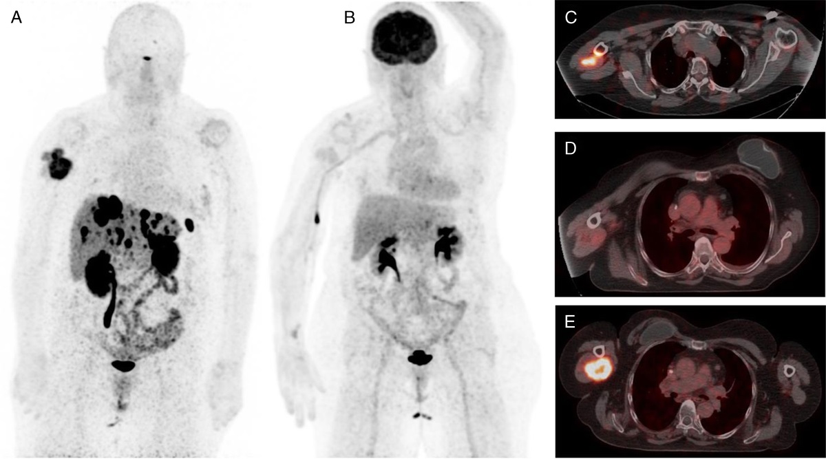 68Ga-DOTATOC PET/CT Imaging of a Muscular Solitary Fibrous Tumor