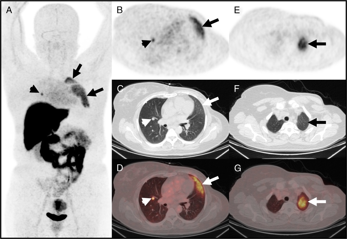 Increased 18F-Fluoroestradiol Uptake of Radiation Pneumonitis in a Patient With Metastatic Breast Cancer