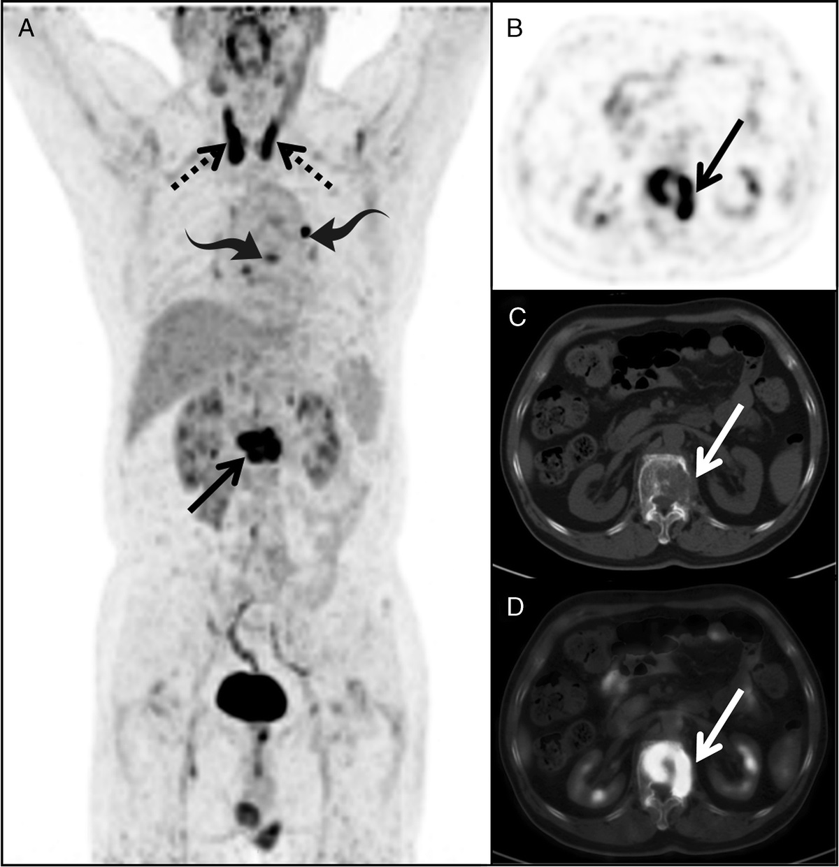 Solitary Malignant Peripheral Nerve Sheath Tumor of Lumbar Vertebra Mimicking Metastatic Malignancy
