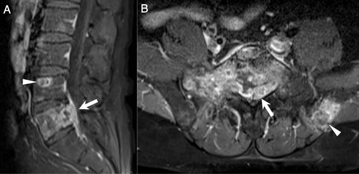 68Ga-FAPI-04 PET/CT in a Small Sarcomatoid Renal Cell Carcinoma With Widespread Metastases