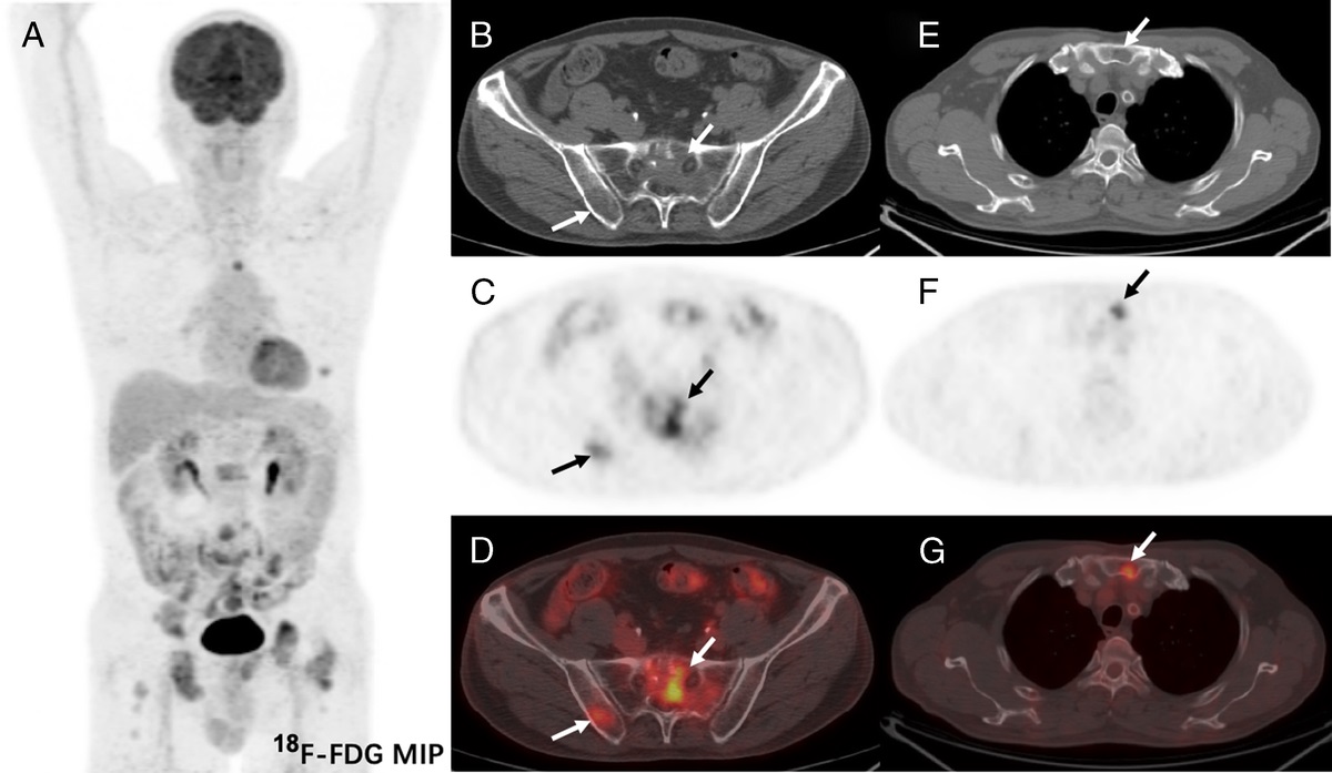 68Ga-FAPI Versus 18F-FDG PET/CT in the Evaluation of Epithelioid Hemangioendothelioma of Bone