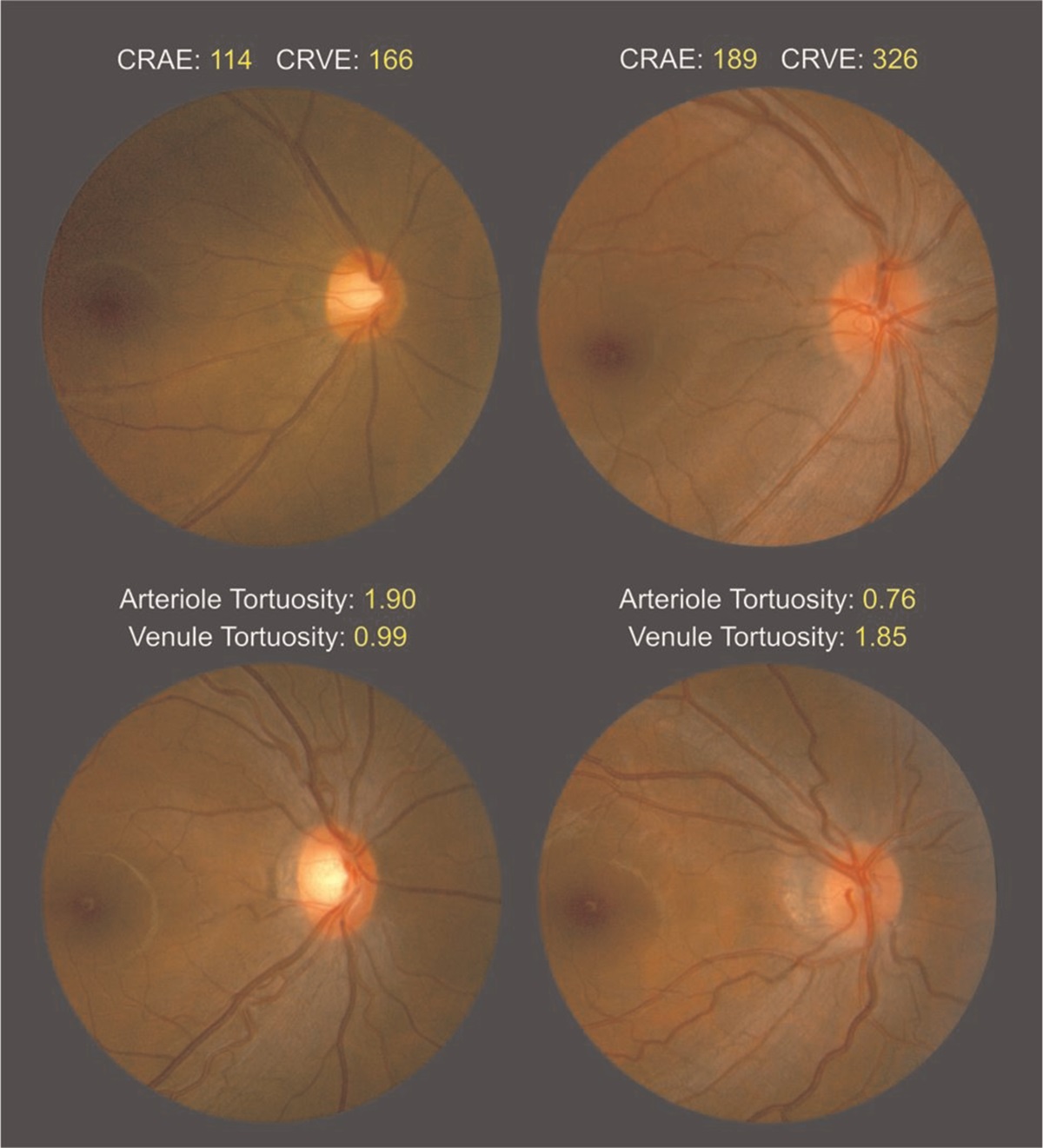 Retinal vessel caliber and tortuosity and prediction of 5-year incidence of hypertension