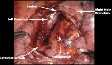 Tracheobronchoplasty