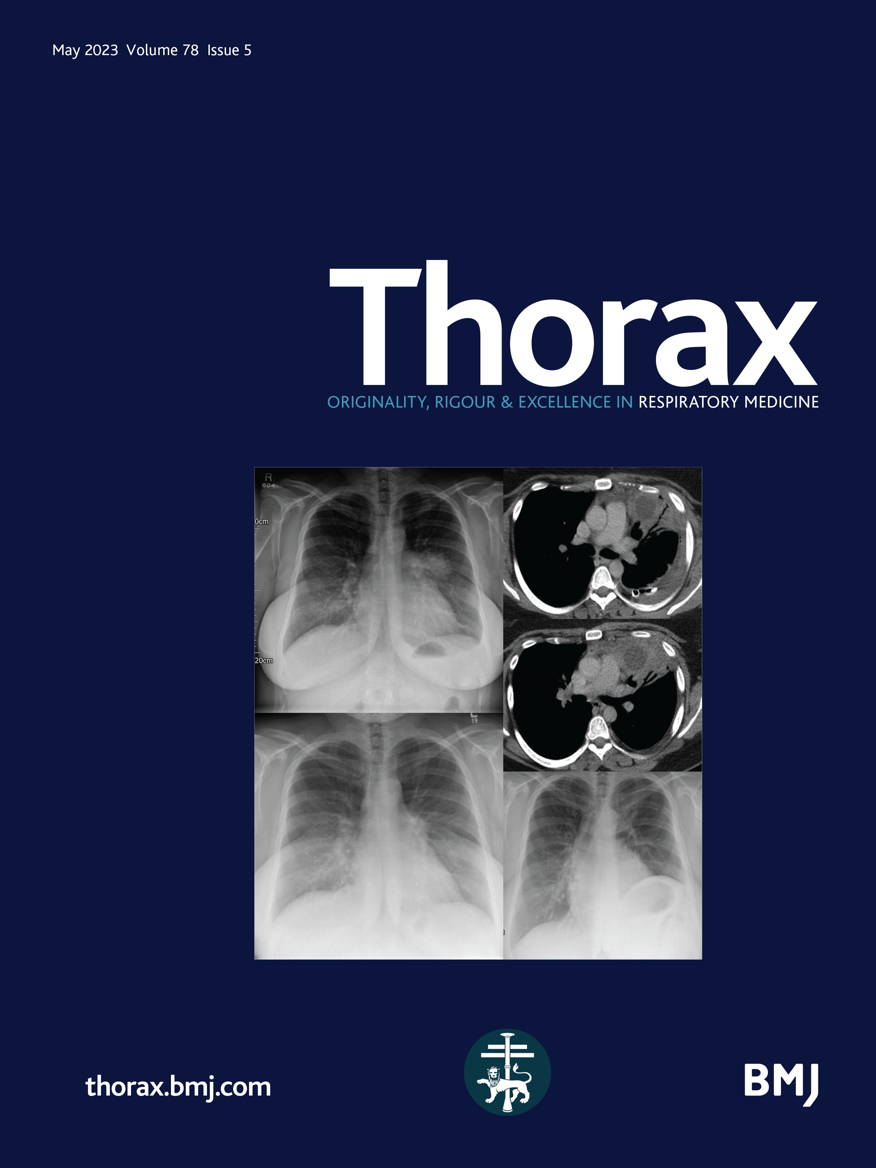 Ultra-low-dose CT versus chest X-ray for patients suspected of pulmonary disease at the emergency department: a multicentre randomised clinical trial