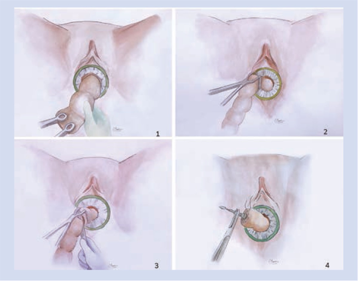 Laparoscopic Low Anterior Resection for Severe Deep Pelvic Endometriosis (Stage IV) With Hybrid Notes Technique for Specimen Extraction and Anvil Insertion