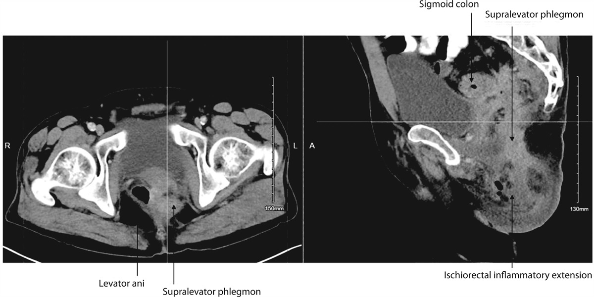 Evaluation and Management of Supralevator Abscess
