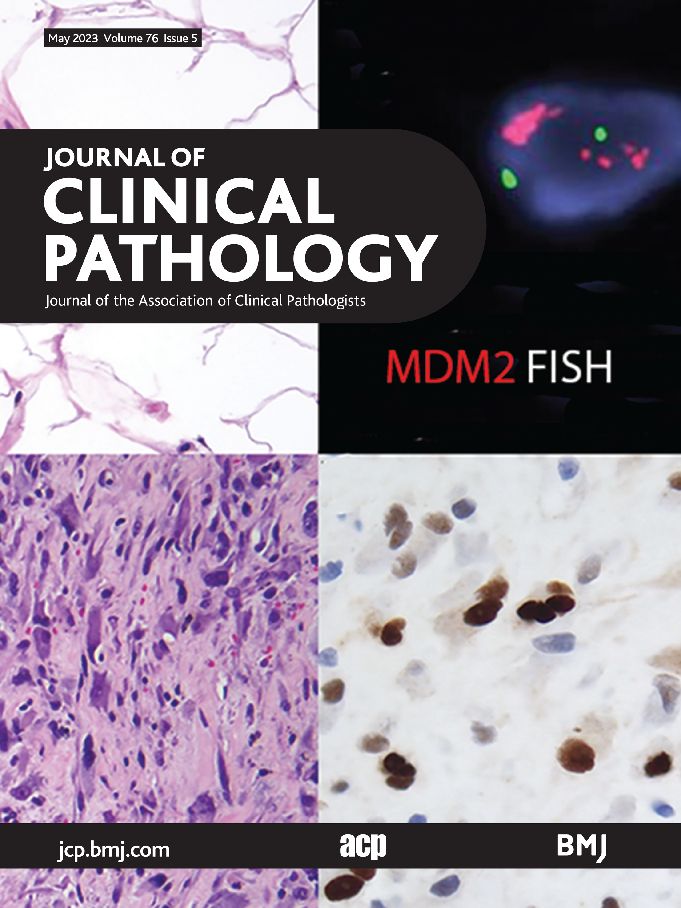 BAP1-deficient meningioma presenting with trabecular architecture and cytokeratin expression: a report of two cases and review of the literature
