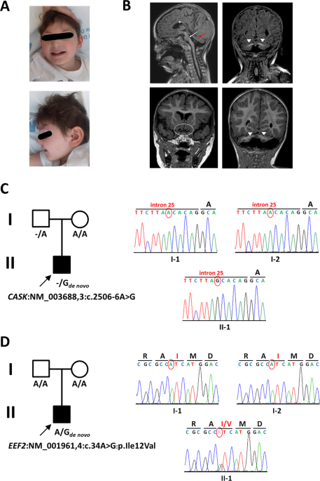 A novel de novo variant in CASK causes a severe neurodevelopmental disorder that masks the phenotype of a novel de novo variant in EEF2